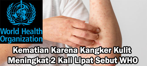 Kematian Karena Kangker Kulit Meningkat 2 Kali Lipat Sebut WHO