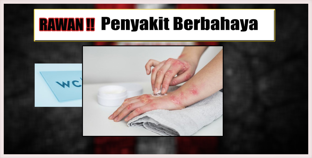 Penyakit Berbahaya Menyebabkan Gatal
